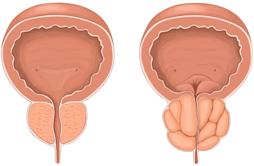 Kas notiek ar prostatu prostatīta laikā