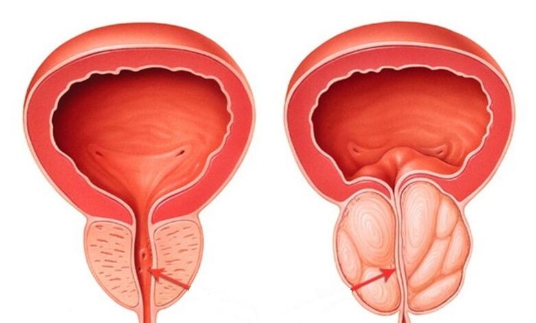 Veselīga un iekaisusi prostatu ar prostatītu