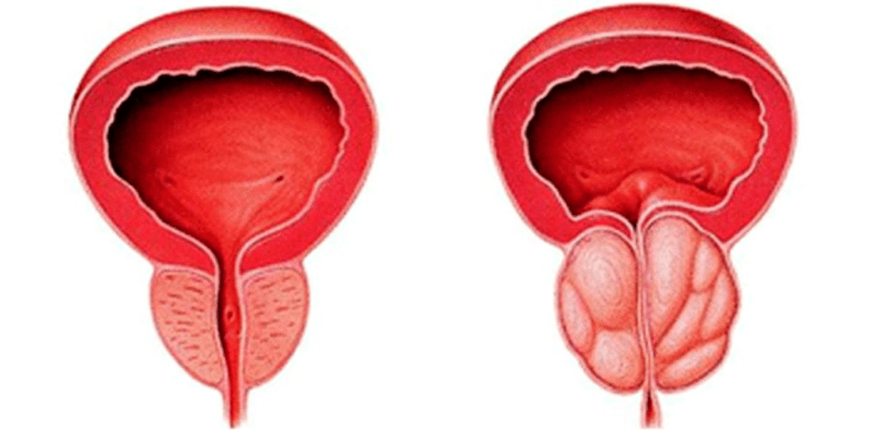 Normāls un iekaisis prostatas dziedzeris